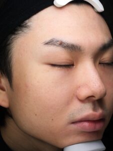 男性のニキビ症例②施術後