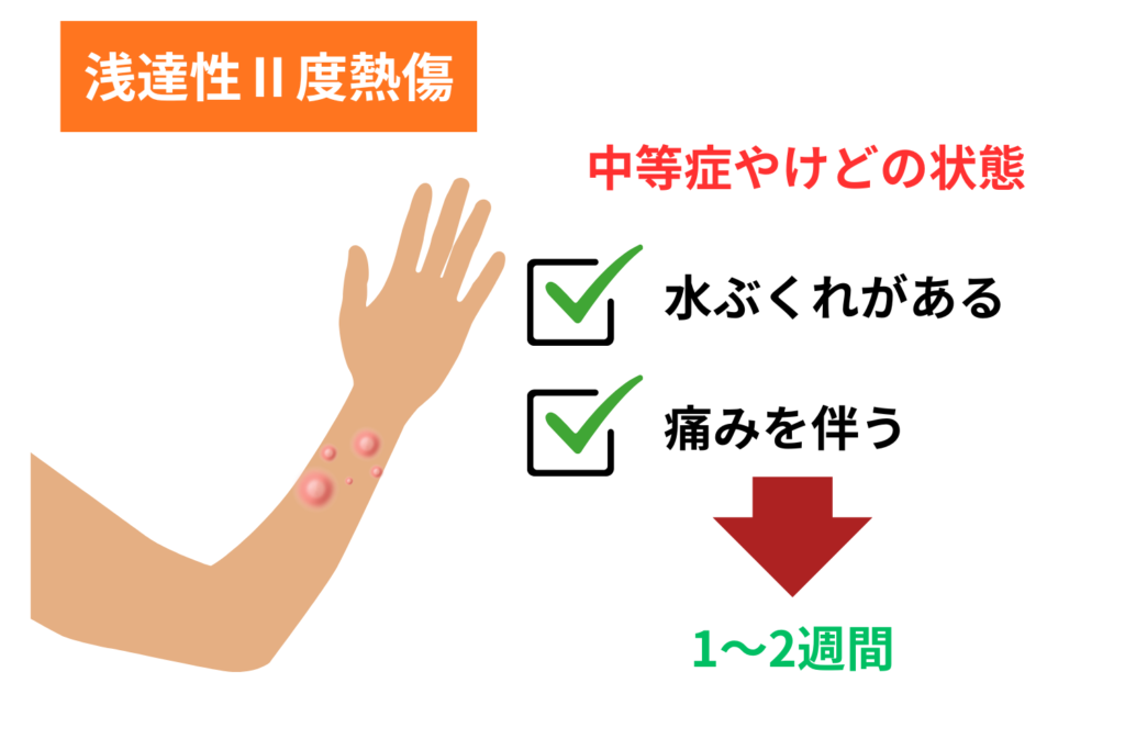 浅達性Ⅱ度熱傷：水ぶくれと強い痛み（1〜2週間）
