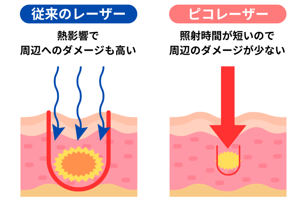 ダウンタイムが少ない