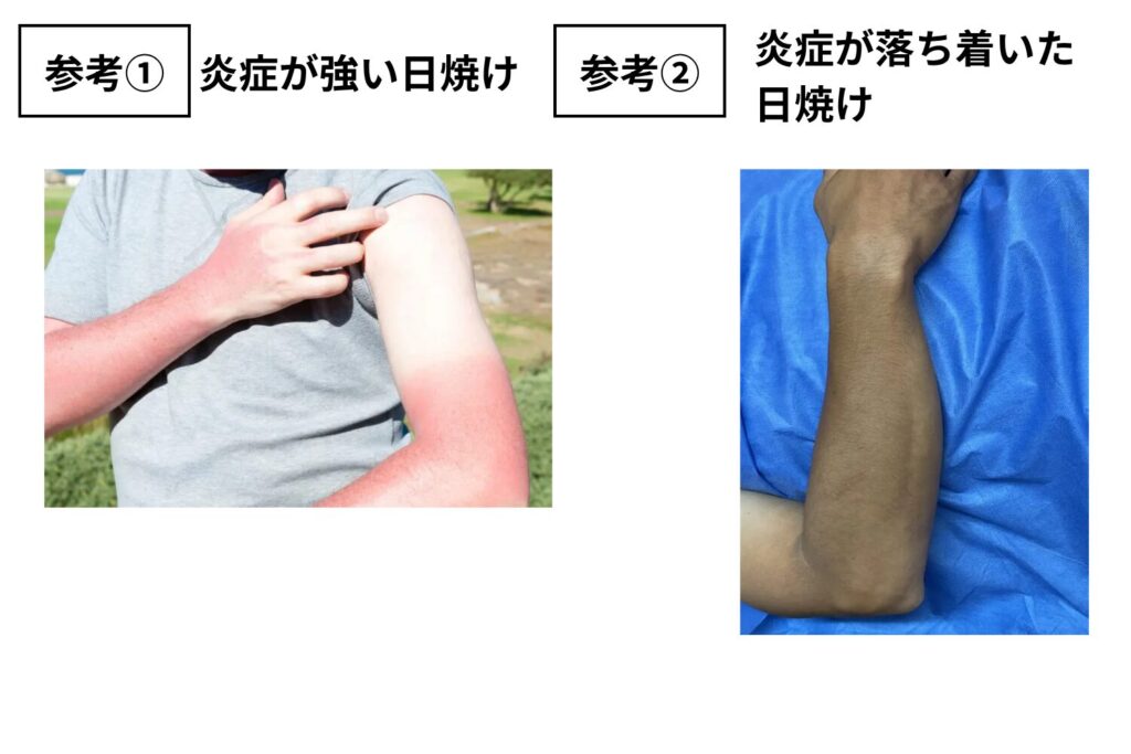 日焼け・地黒肌によるレーザーの過剰反応