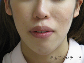 アフター