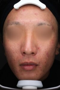 ニキビビフォー