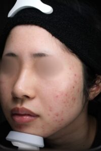 ニキビ