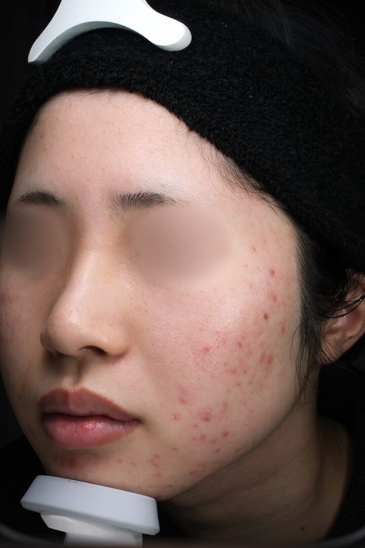 ニキビ