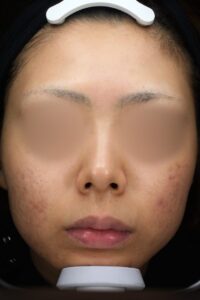 ニキビアフター