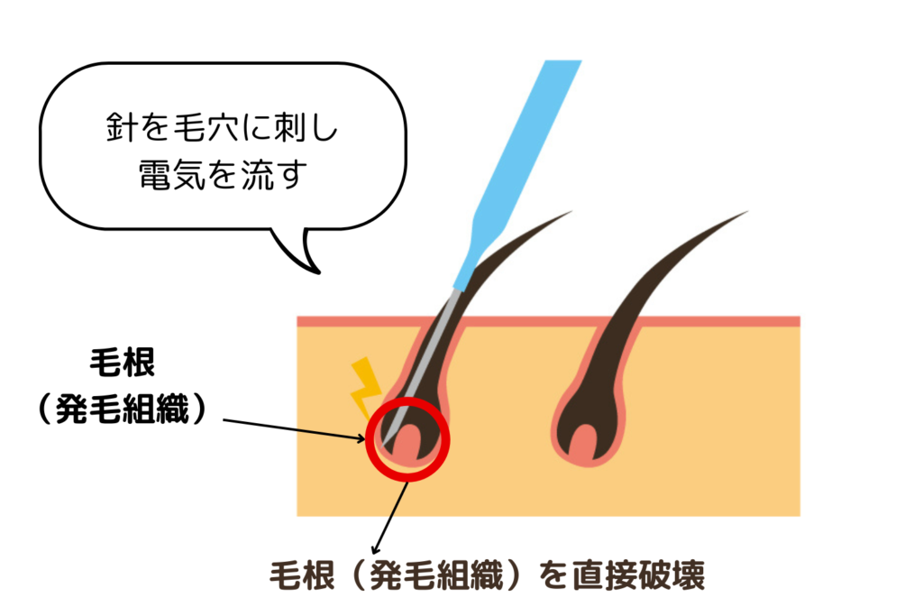 医療レーザー脱毛とニードル脱毛の違い