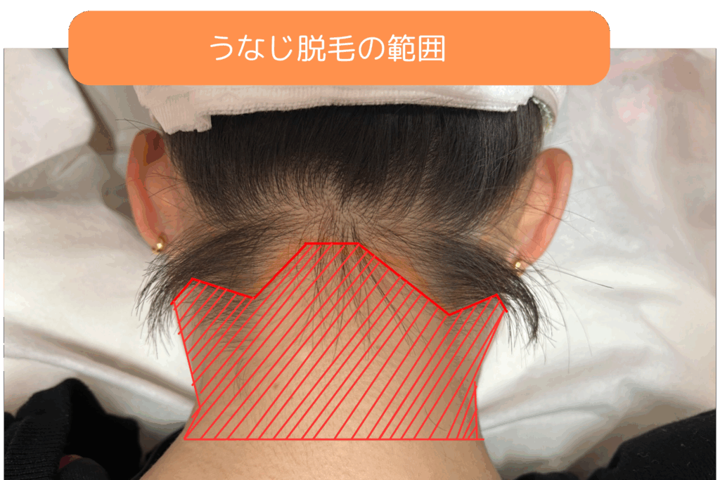 うなじ脱毛の範囲