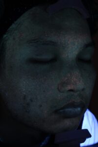 ニキビビフォー