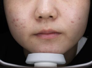 ニキビアフター