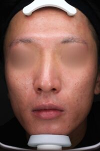 ニキビアフター