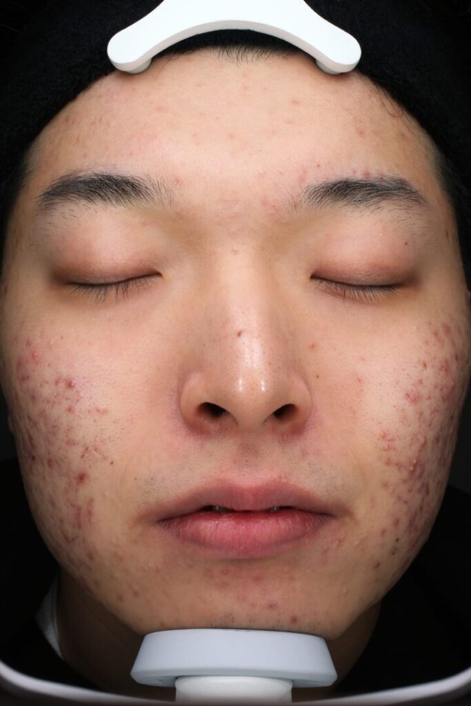 ニキビビフォー