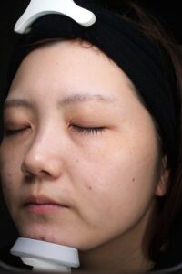 ニキビ症例後