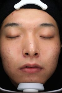 ニキビアフター