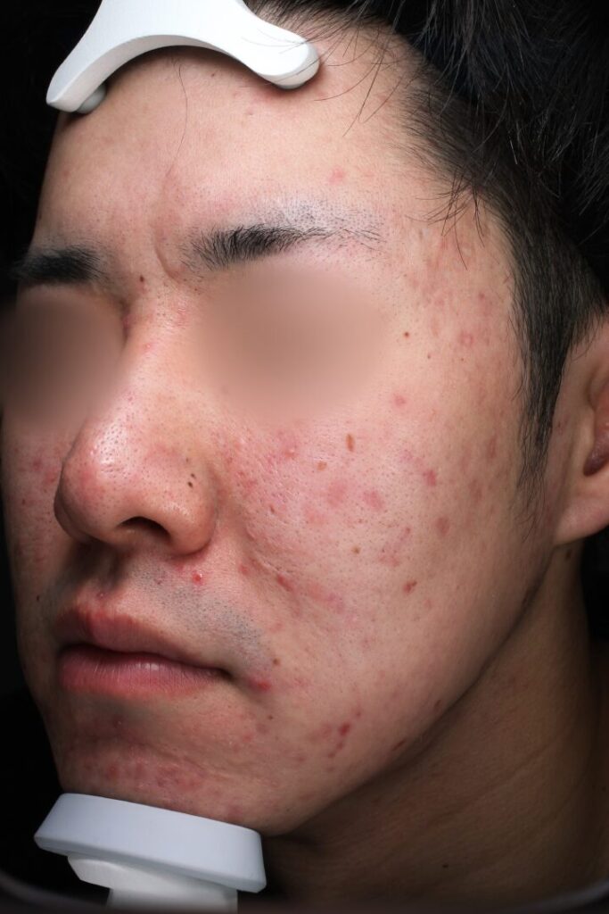 ニキビ