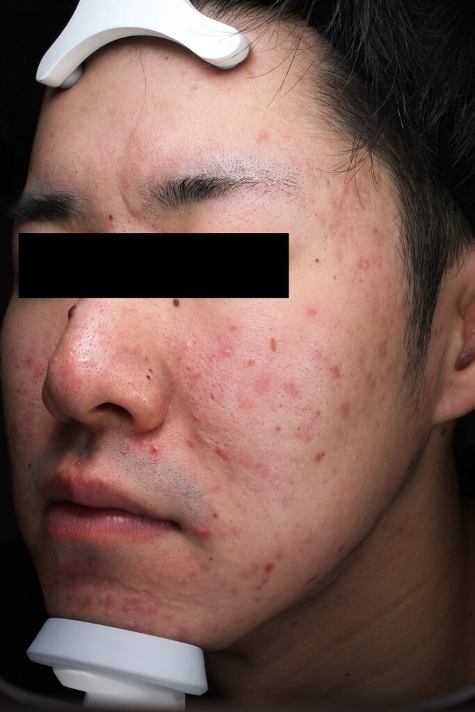 ニキビ症例前