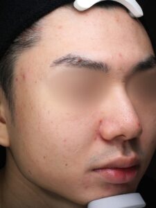 ニキビビフォー