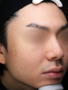 ニキビアフター