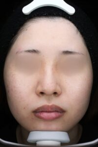 ニキビアフター