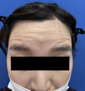 額ボトックス注射（施術前）