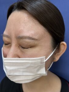 目尻ボトックス（施術後）
