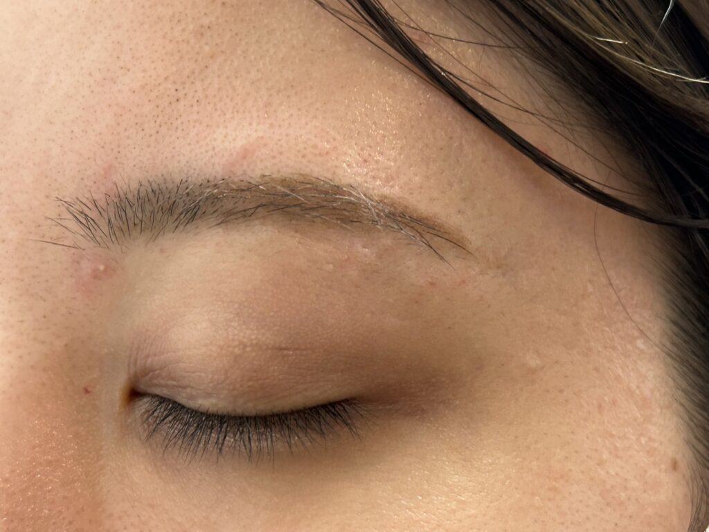 まゆげ脱毛（ニードル）施術後