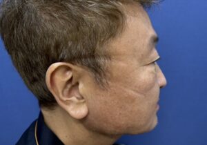 ニードル脱毛施術後