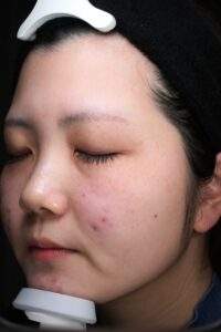 ニキビ症例前