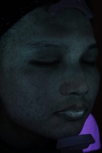 ニキビアフター