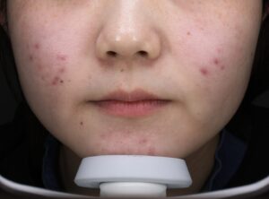 ニキビビフォー