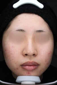 ニキビビフォー