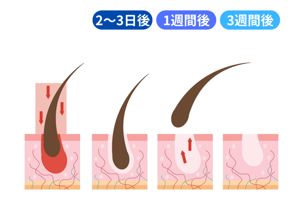 髭が抜けるまでのプロセス