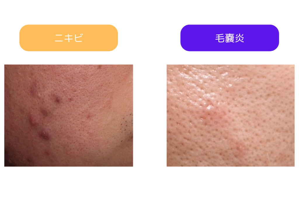 ニキビとの見分け方