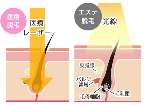 髭脱毛後に髭が抜けるまでの期間