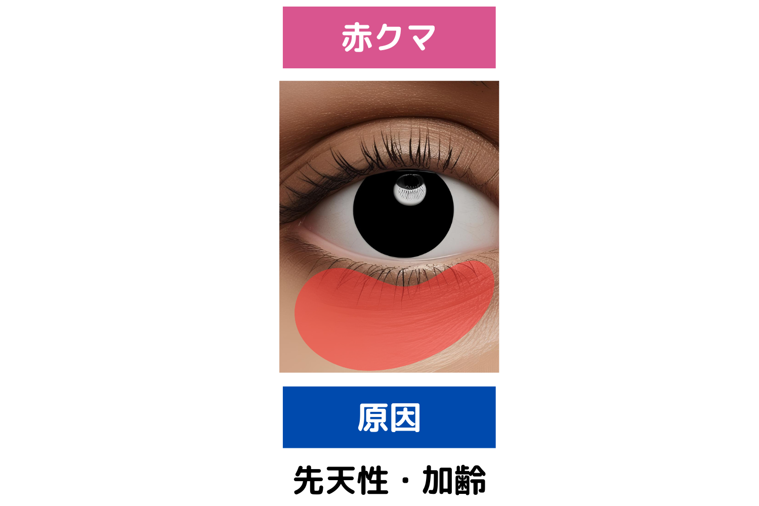 赤クマ:目元の薄さや疲れが気になる方