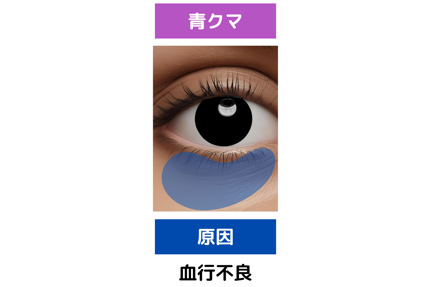 青クマ:ストレスや睡眠不足が気になる方