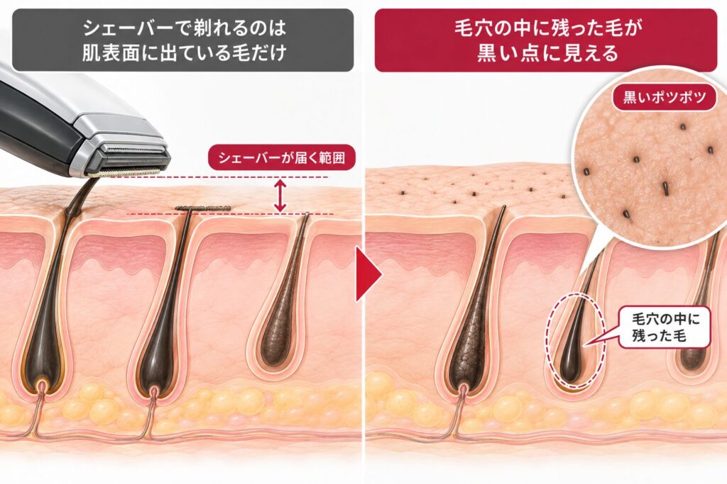 燃えカスの残存と皮膚の黒ずみ