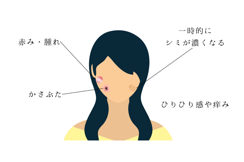 シミ取りレーザー後に現れる主な症状