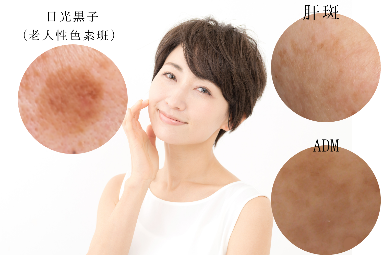 シミ取りレーザー治療の種類と特徴