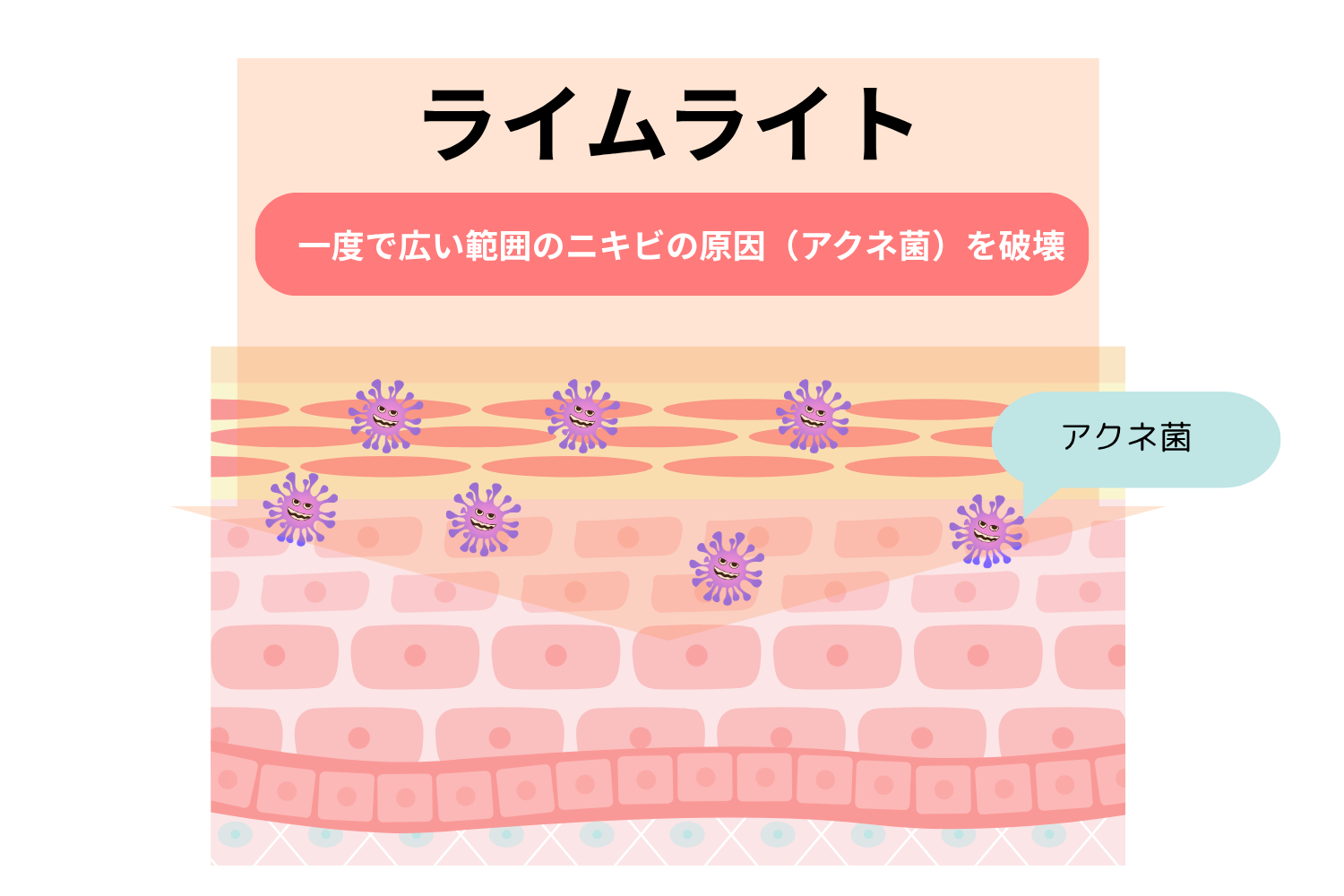 ライムライトがニキビにも効果的な理由