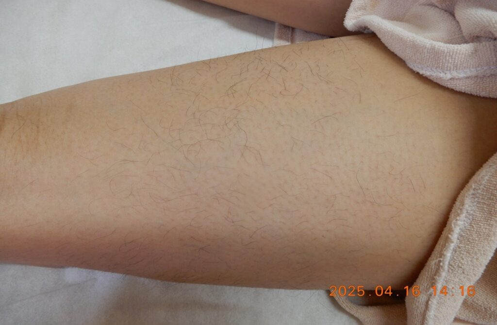 足脱毛ビフォー