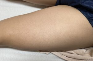 足脱毛アフター