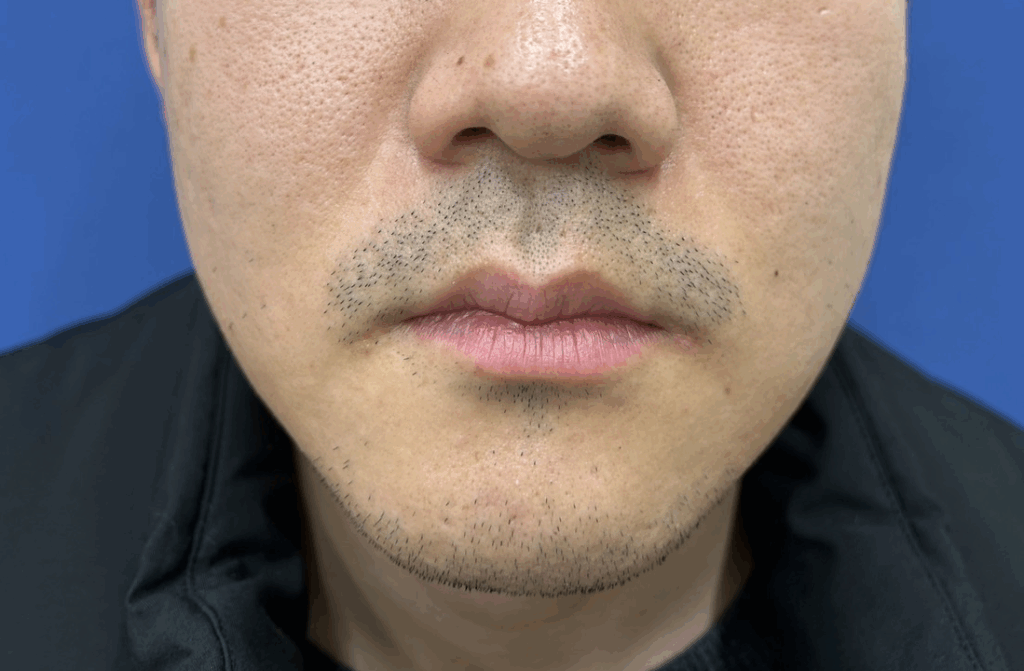 髭脱毛後の「泥棒髭」とは