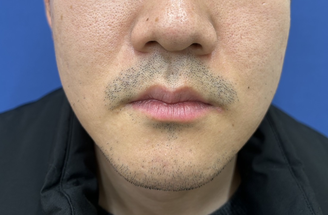 髭脱毛でも鼻下が抜けない・しぶといのはなぜ？