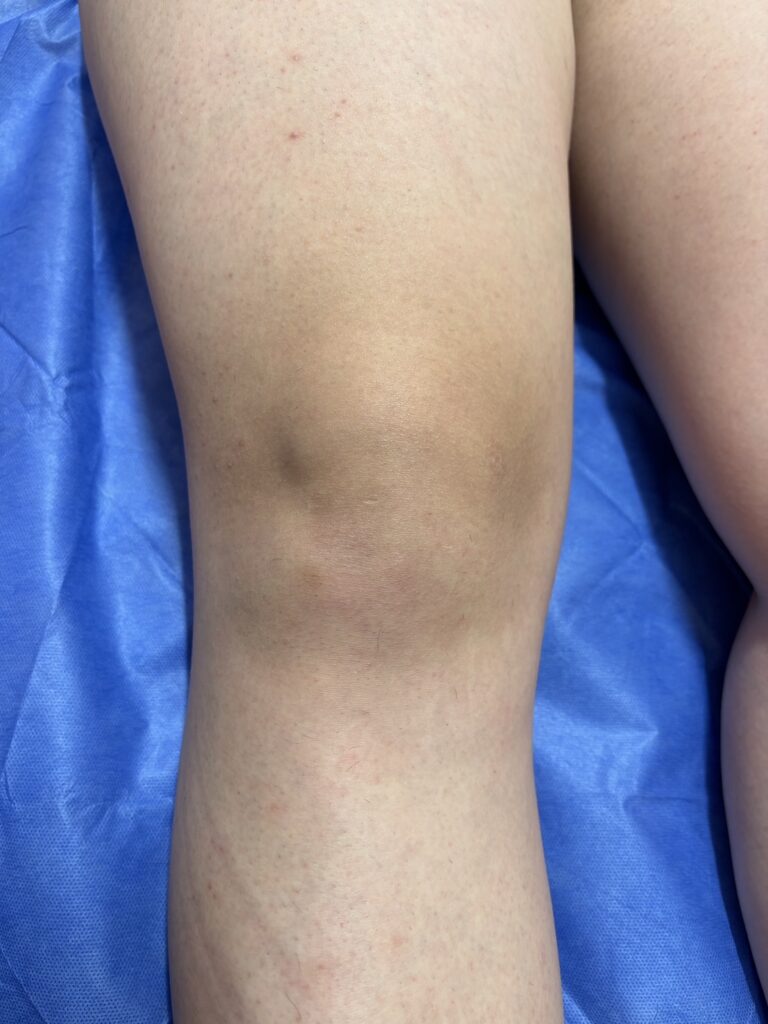 足脱毛アフター