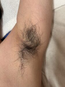 ワキ脱毛ビフォー