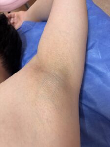 ワキ脱毛アフター