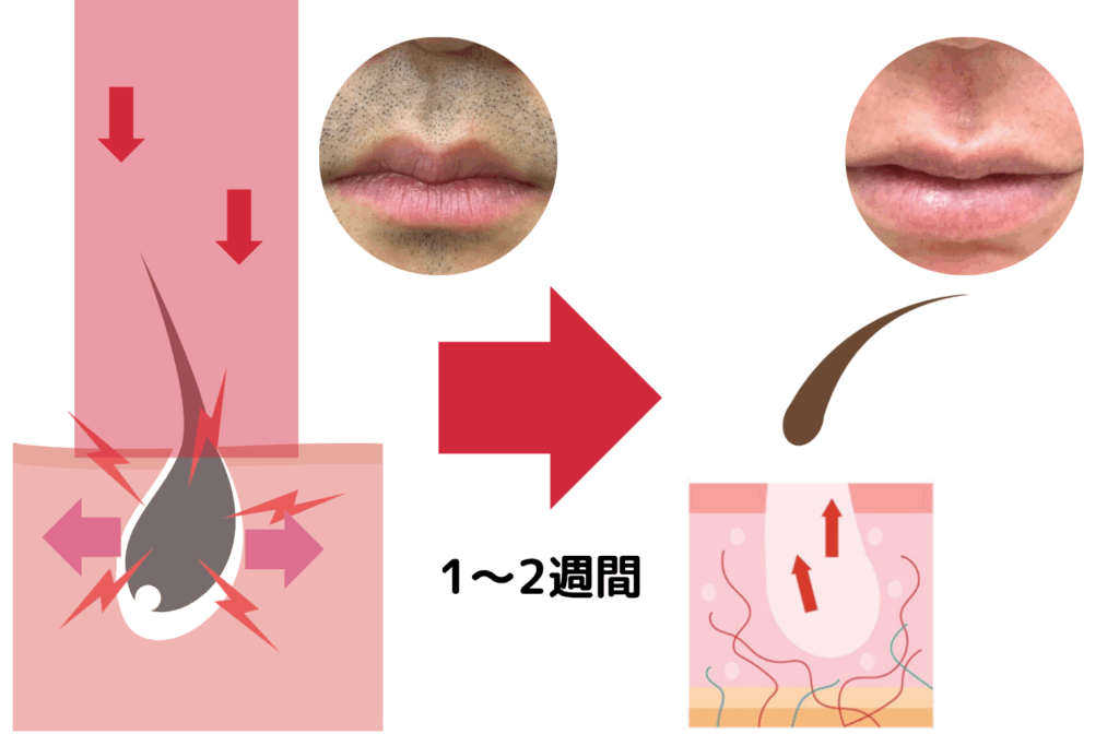 泥棒髭が起こるメカニズム