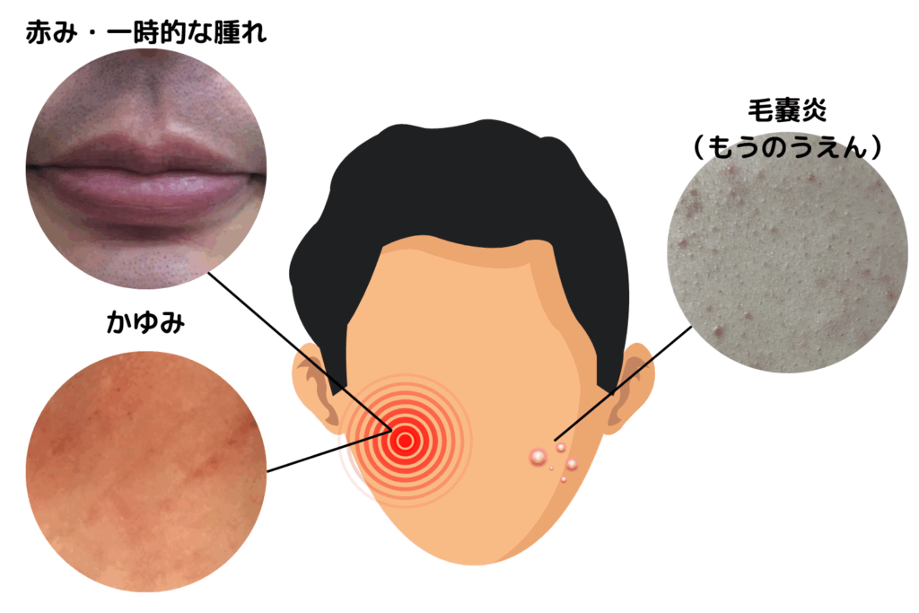 そもそも髭脱毛のダウンタイムとは?