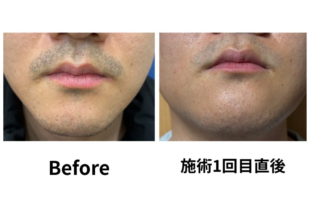 ヒゲ脱毛直後にヒゲは濃くなる?