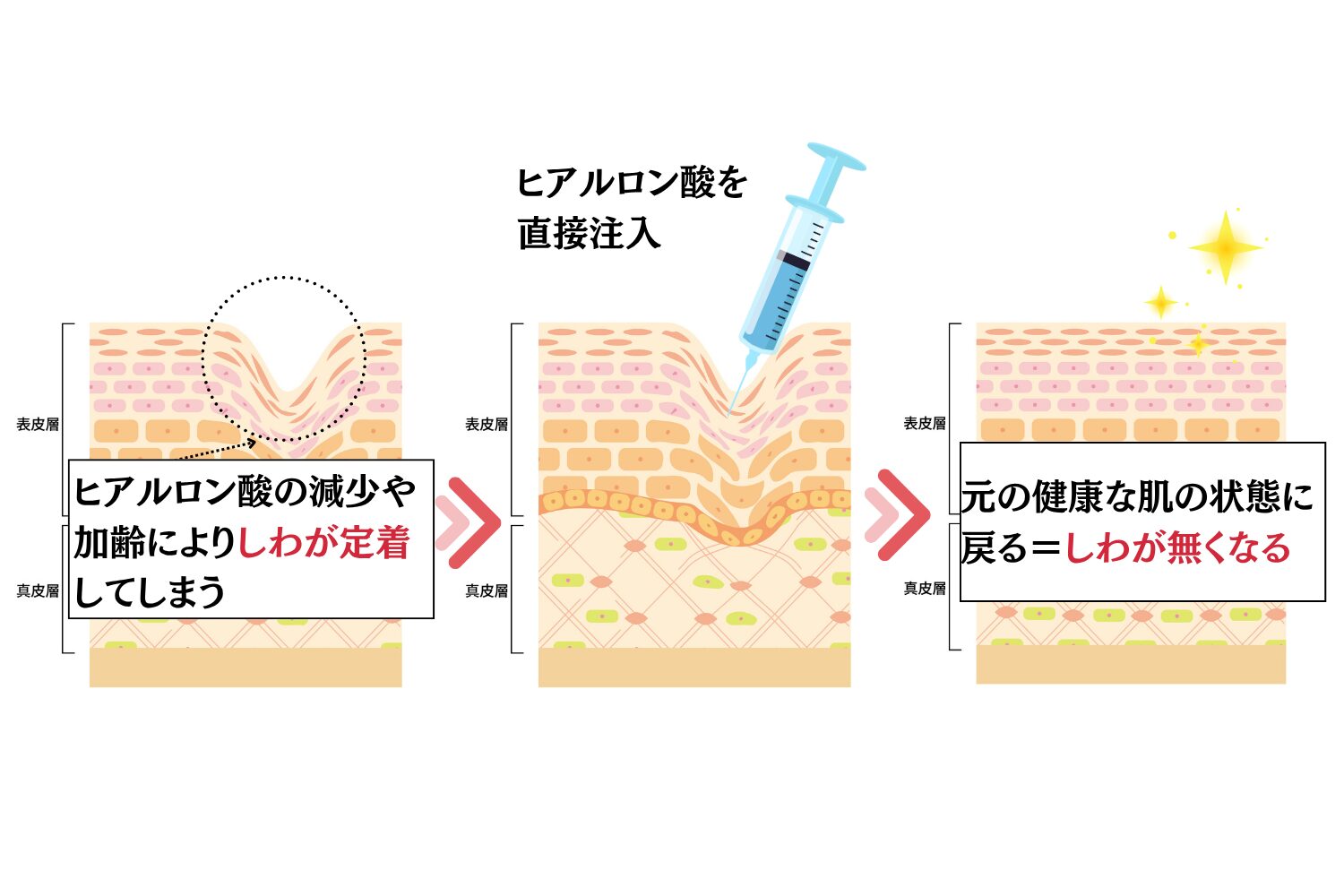 【40代以降に人気】しわを改善したい